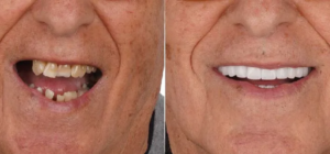implant yaptırmadan öncesi ve sonrası öneriler